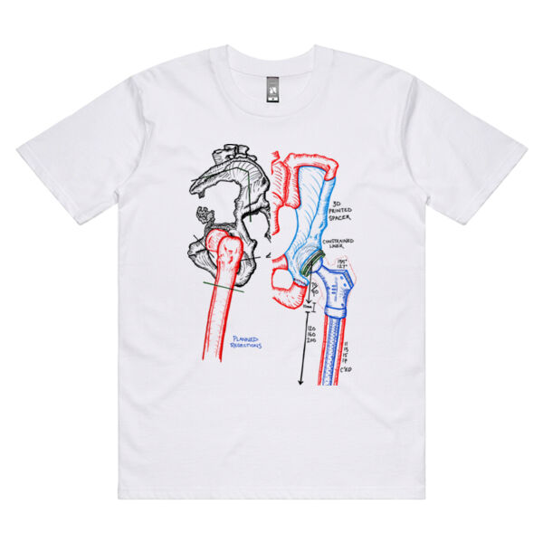 Pelvic resection  Thumbnail